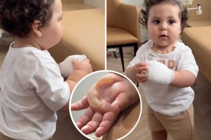 Viih Tube mostra como ficou a mão do filho após queimadura -  (crédito: Observatório dos Famosos)