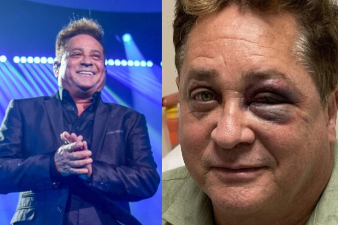 Leonardo manda a real após viralizar com olho roxo: “Tamanho de uma jaca” -  (crédito: Observatório dos Famosos)
