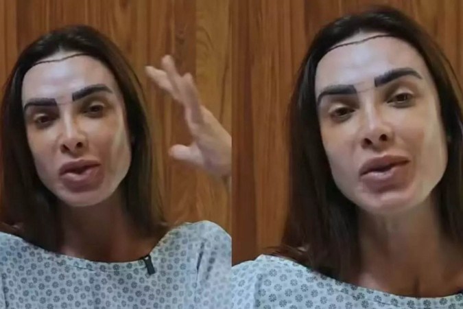 Nicole Bahls faz transplante capilar com técnica discreta e explica decisão -  (crédito: Observatório dos Famosos)