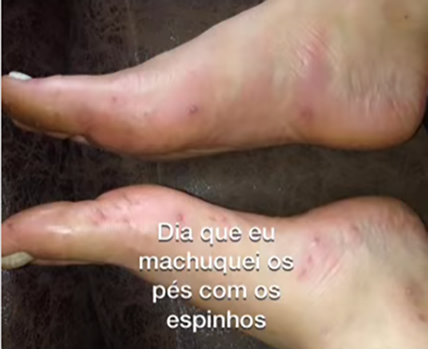 Gabriela passou pomada, álcool, desinfetou os pés, e achou que estaria tudo bem. 